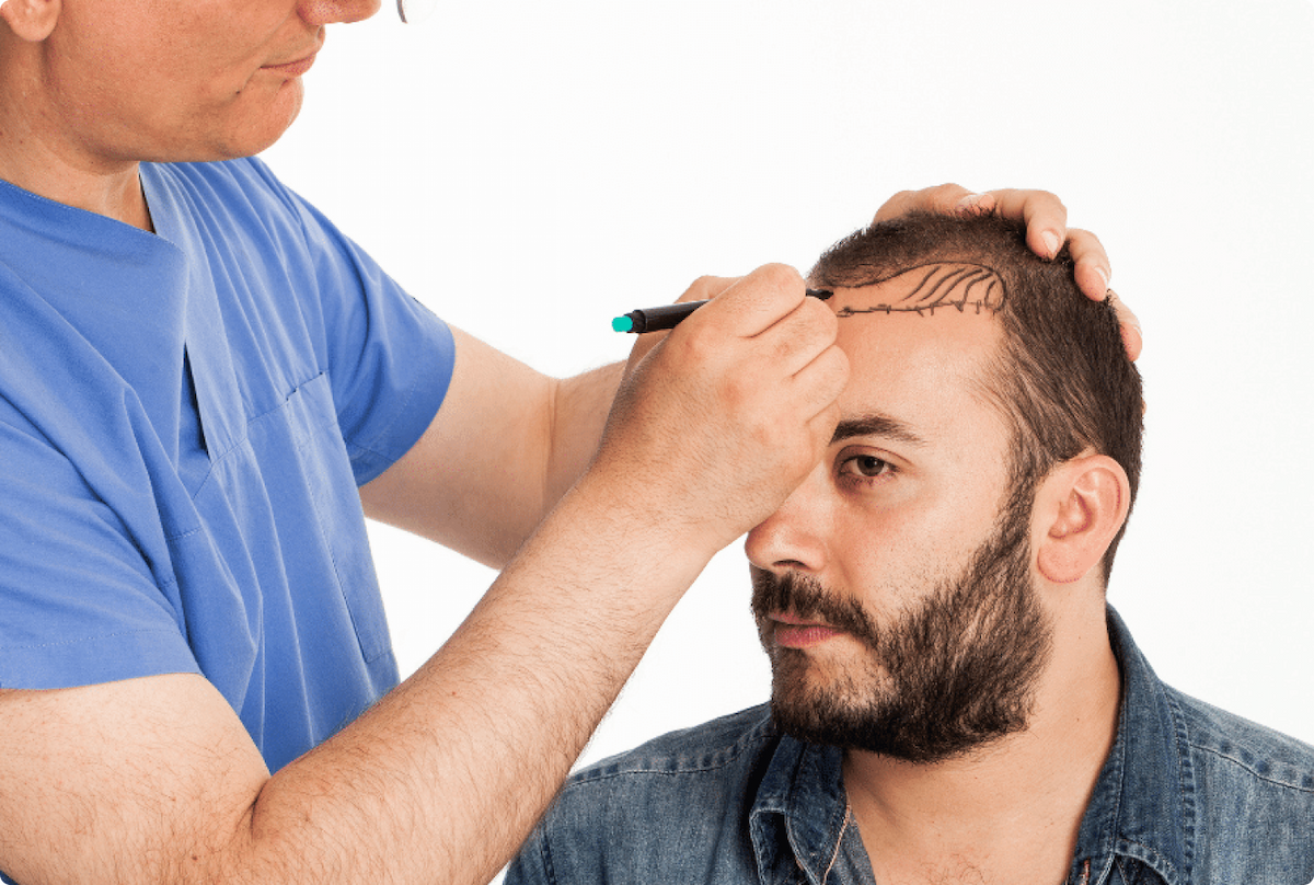 What is Hair Transplant? What Should Be Considered Before?