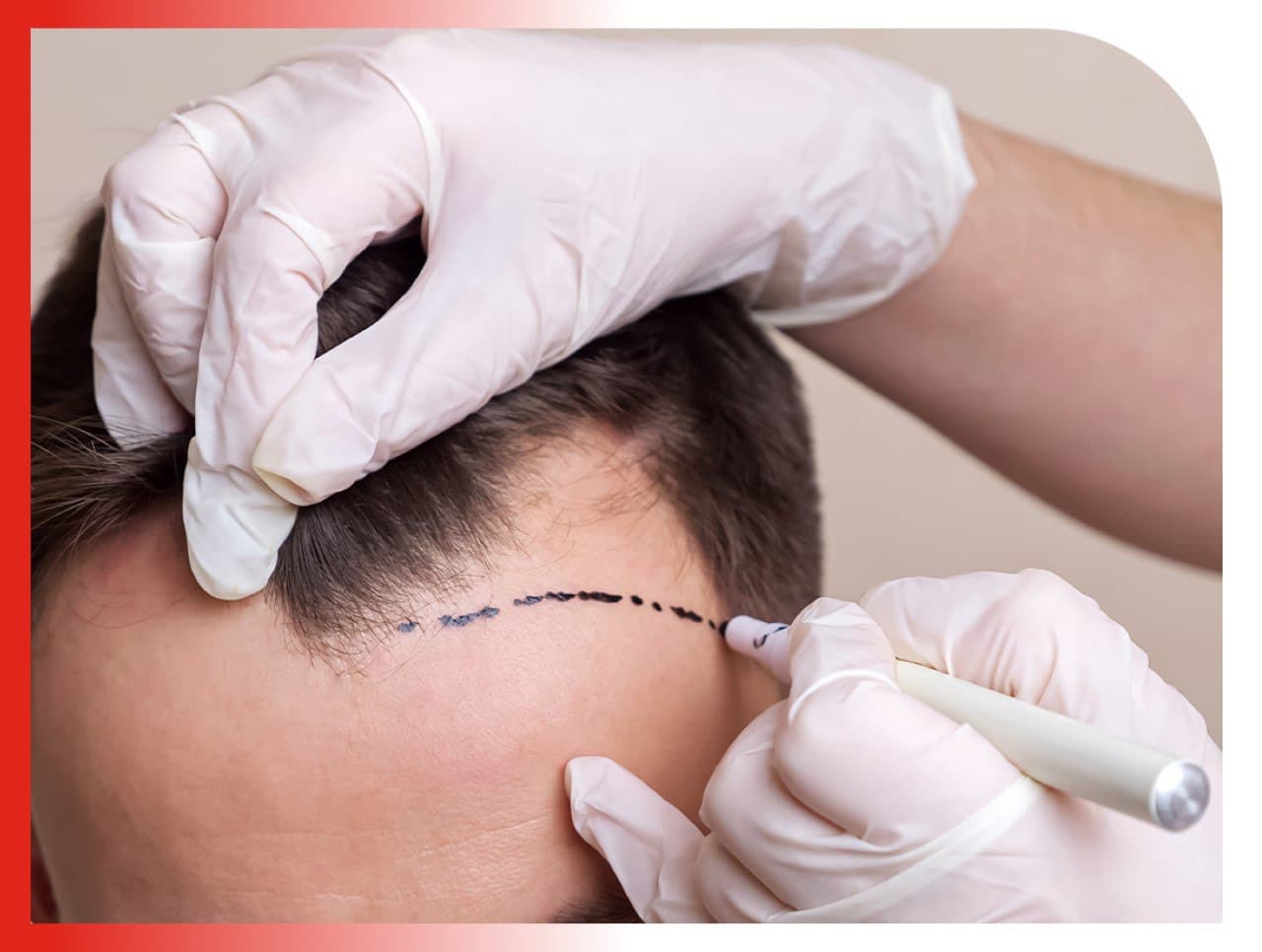 DHI Hair Transplant: An Innovative Approach for Natural and Dense Hair